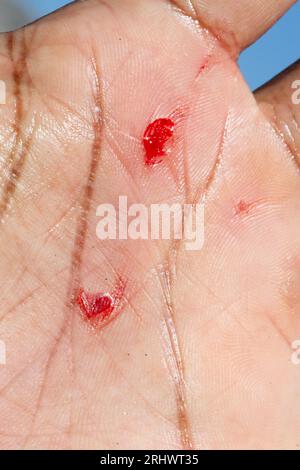 Blutungswunde an der Hand eines Mannes nach einem Unfall. Makro von Schnitten auf menschlicher Haut mit Blutverlust. Arbeitsunfallkonzept. Stockfoto