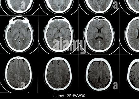 Mehrschicht-CT-Scan des Gehirns mit großem Hirnstamm und semiovalen Hämatom des rechten Zentrums, normalen hinteren Fossa-Strukturen, normaler Vent-Größe Stockfoto