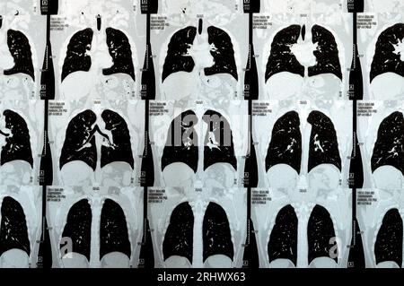 Mehrschicht-CT-Scan der Brust mit normaler Untersuchung, normalem Lungenbild, Parenchym, Lungengefäß, mediastinalen Strukturen, nein Stockfoto