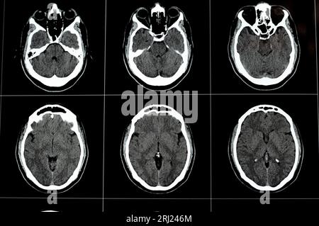 Gehirn-CT-Scan mit Hirnstamm-Kavernom, semiovale Entwicklungsvenenanomalie des rechten Zentrums, intrazerebralem Hämatom, schwacher Hypodichter Läsion in m Stockfoto