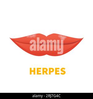 Herpes HSV Lippenherpes Ausbruch medizinisches Symbol Stock Vektor