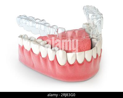 Invisalign unsichtbarer Halter oder Klammern mit lasierender Backe auf weiß. 3D-Abbildung Stockfoto