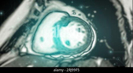 MRT Herz oder Herz-MRT ( Magnetresonanztomographie ) des Herzens zur Diagnostik der Herzkrankheit. Stockfoto