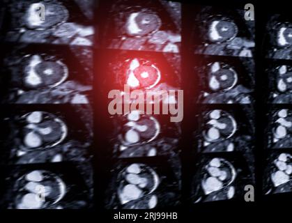 MRT Herz oder Herz-MRT ( Magnetresonanztomographie ) des Herzens zur Diagnostik der Herzkrankheit. Stockfoto