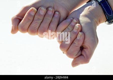 Pilznagelinfektion, Onycholyse nach Schellack oder Gellack Stockfoto