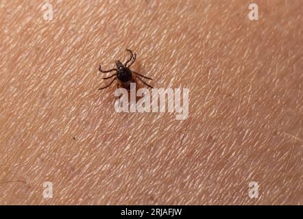 Infizierte weibliche Hirschzecke auf behaarter menschlicher Haut. Ixodes ricinus. Parasitäre Milbe. Acarus. Gefährliches Bissinsekt auf Epidermis-Detailhintergrund. Disg Stockfoto