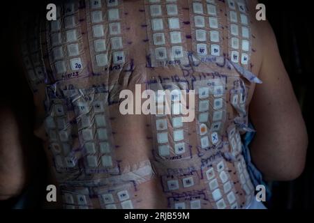 Allergy Patch Testing England Photo Model Releaed August 2023 Ein Patch Test ist eine diagnostische Methode, die verwendet wird, um zu bestimmen, welche spezifischen Substanzen cau Stockfoto