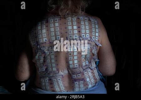 Allergy Patch Testing England Photo Model Releaed August 2023 Ein Patch Test ist eine diagnostische Methode, die verwendet wird, um zu bestimmen, welche spezifischen Substanzen cau Stockfoto