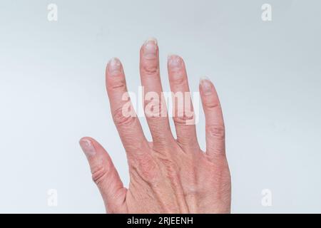 Nahaufnahme einer uralten Frauenhand mit Falten mit natürlichen Nägeln, überwucherter Kutikula auf weißem Hintergrund. Schiefe Finger, Gicht. Eine Hand mit Age-R Stockfoto