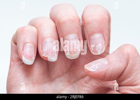 Schuppige gebissene und brüchige Nägel ohne Maniküre. Nachwachsende Nagelkutikula und beschädigte Nagelplatte nach Gelpolitur. Stockfoto