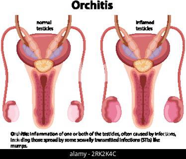 Vector cartoon illustration of male orchitis testis sickness Stock Vector