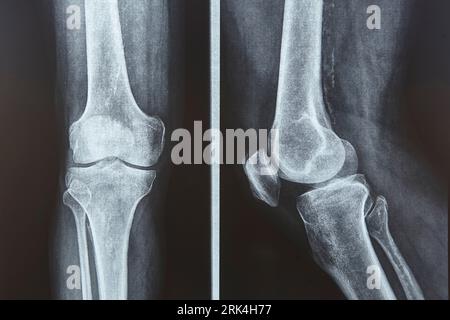 Kniestrahlung. Front- und Seitenansicht. Gesundheitswesen. Bilddiagnose Stockfoto