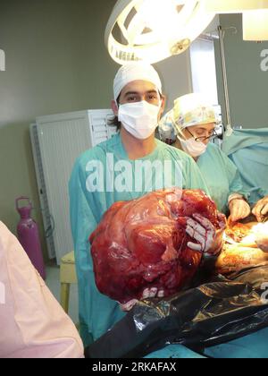 Bildnummer: 54343529 Datum: 01.08.2010 Copyright: imago/Xinhua das Foto zeigt einen Arzt des Krankenhauses Gandulfo im argentinischen Lomas de Zamora, der einen 23 Kilogramm schweren Gebärmutterhals-Tumor von einer 54-jährigen Patientin hält. Das Gesundheitsbüro der Provinz Buenos Aires gab am 24. August 2010 bekannt, dass die kürzlich durchgeführte Operation erfolgreich war. (Xinhua) (ypf) ARGENTINA-CERVIX TUMOR-23 KG PUBLICATIONxNOTxINxCHN Gesellschaft Medizin Operation OP Saal Operationssaal Uraufführung xint Highlight kbdig xsk 2010 hoch o0 Objekte Tumor o00 kurios Bildnummer 54343529 Datum 01 08 2010 Copyright Imago XINHUA Th Stockfoto