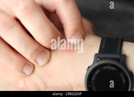 Der Mann kratzt an roten Flecken auf der Nahaufnahme des Handgelenks Stockfoto