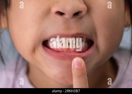 Kopfschuss-Bild eines süßen Mädchens im Vorschulalter, das weit lächelt und Milchzähne zeigt. Nahaufnahme der weißen Zähne eines Kindes. Stockfoto