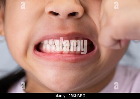 Kopfschuss-Bild eines süßen Mädchens im Vorschulalter, das weit lächelt und Milchzähne zeigt. Nahaufnahme der weißen Zähne eines Kindes. Stockfoto