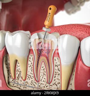 Querschnitt des menschlichen Zahnes mit endodontischer Drehfeile. 3D-Abbildung Stockfoto