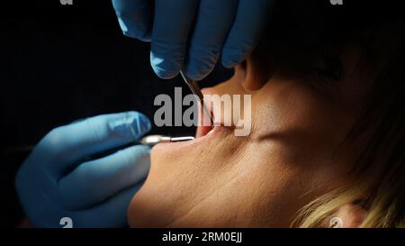 Zahnärztliche Behandlung. Frau, die ihre Zähne säuberte und eine Implantatbehandlung erhielt Stockfoto