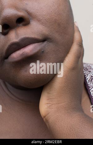 Braune Haut mit dunklen Flecken, Hyperpigmentierung auf brauner Haut, afroamerikanische Frau mit Hautflecken, unvollkommene Haut Stockfoto