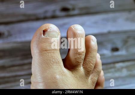 Blutung der großen Zehe des rechten Fußes, Beleidigung der Fußzehe, was zu einer blutenden Wunde führt, die Pflege und Verband benötigt, Blut auf Zehennagel, das Knie Stockfoto