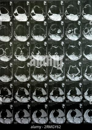 MRT des rechten Knies mit leichtem Gelenkerguss, mit normalen anderen Befunden von PHMM, ACL, MCL, LCL, LM, Bänder, Patella, Sehnen, Nerven, Muskeln Stockfoto