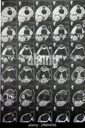 MRT des linken Kniegelenks mit minimalem Gelenkerguss, PHMM-Meniskusdegeneration am Posterior Horn medial, ACL anteriores Kreuzband leichte Verstauchung, n Stockfoto