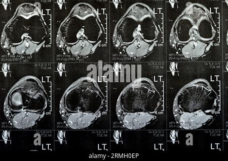 MRT des linken Kniegelenks mit minimalem Gelenkerguss, PHMM-Meniskusdegeneration am Posterior Horn medial, ACL anteriores Kreuzband leichte Verstauchung, n Stockfoto