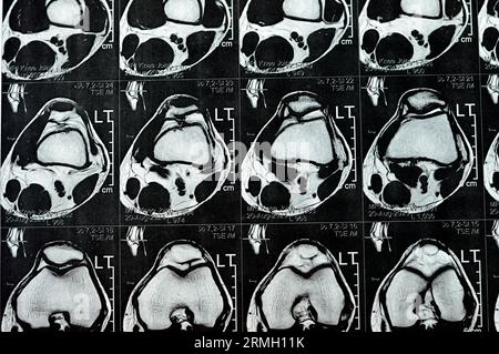 MRT des linken Kniegelenks mit minimalem Gelenkerguss, PHMM-Meniskusdegeneration am Posterior Horn medial, ACL anteriores Kreuzband leichte Verstauchung, n Stockfoto