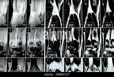 MRT des rechten Knies mit leichtem Gelenkerguss, mit normalen anderen Befunden von PHMM, ACL, MCL, LCL, LM, Bänder, Patella, Sehnen, Nerven, Muskeln Stockfoto