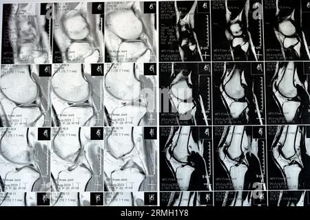 MRT des linken Kniegelenks mit minimalem Gelenkerguss, PHMM-Meniskusdegeneration am Posterior Horn medial, ACL anteriores Kreuzband leichte Verstauchung, n Stockfoto