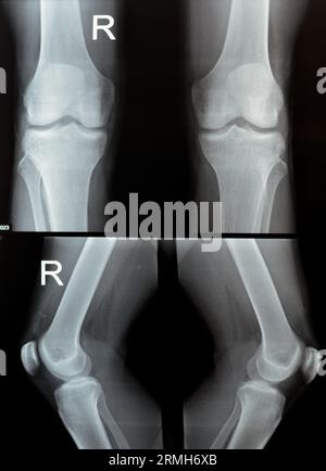 Einfache Röntgenaufnahme des rechten und linken Kniegelenks mit Unterschenkel und Oberschenkelbereich sowie Fibula und Patella mit normaler Knieverbindung von A. Stockfoto