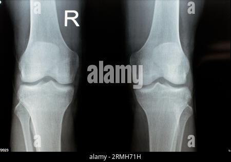 Einfache Röntgenaufnahme des rechten und linken Kniegelenks mit Unterschenkel und Oberschenkelbereich sowie Fibula und Patella mit normaler Knieverbindung von A. Stockfoto