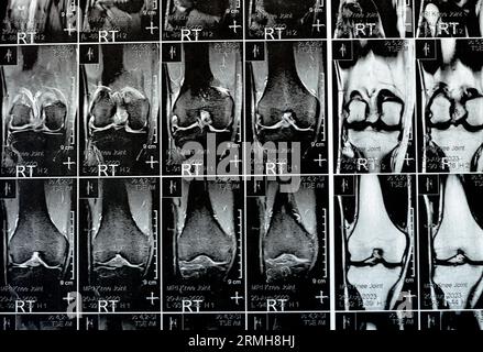 MRT des rechten Knies mit leichtem Gelenkerguss, mit normalen anderen Befunden von PHMM, ACL, MCL, LCL, LM, Bänder, Patella, Sehnen, Nerven, Muskeln Stockfoto