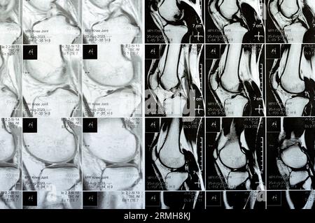 MRT des rechten Knies mit leichtem Gelenkerguss, mit normalen anderen Befunden von PHMM, ACL, MCL, LCL, LM, Bänder, Patella, Sehnen, Nerven, Muskeln Stockfoto