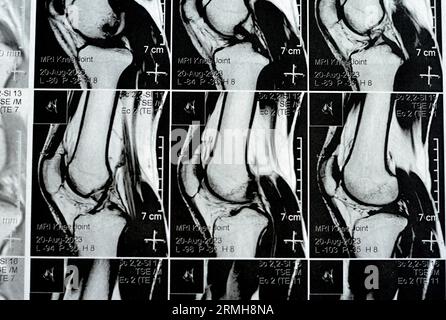 MRT des rechten Knies mit leichtem Gelenkerguss, mit normalen anderen Befunden von PHMM, ACL, MCL, LCL, LM, Bänder, Patella, Sehnen, Nerven, Muskeln Stockfoto