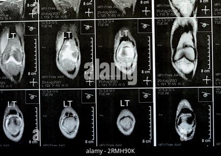 MRT des linken Kniegelenks mit minimalem Gelenkerguss, PHMM-Meniskusdegeneration am Posterior Horn medial, ACL anteriores Kreuzband leichte Verstauchung, n Stockfoto