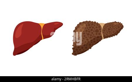 Fettleberkrankheit. Ungesunde kranke Leber und starke gesunde Leber. Die Anatomie des Verdauungssystems. Fibrose und Zirrhose. Vektorillustration isoliert. Stock Vektor