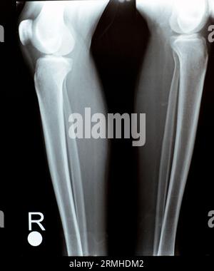 Einfache Röntgenaufnahme des rechten und linken Kniegelenks mit Unterschenkel und Oberschenkelbereich sowie Fibula und Patella mit normaler Knieverbindung von A. Stockfoto