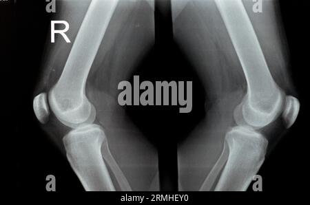 Einfache Röntgenaufnahme des rechten und linken Kniegelenks mit Unterschenkel und Oberschenkelbereich sowie Fibula und Patella mit normaler Knieverbindung von A. Stockfoto