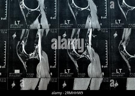 MRT des linken Kniegelenks mit minimalem Gelenkerguss, PHMM-Meniskusdegeneration am Posterior Horn medial, ACL anteriores Kreuzband leichte Verstauchung, n Stockfoto