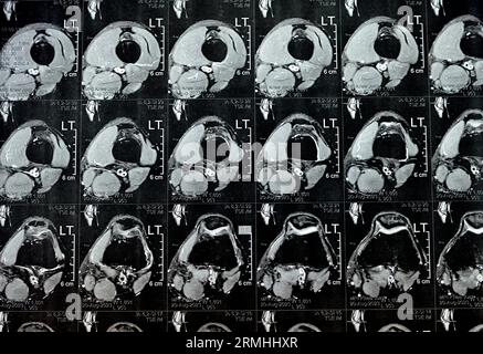 MRT des linken Kniegelenks mit minimalem Gelenkerguss, PHMM-Meniskusdegeneration am Posterior Horn medial, ACL anteriores Kreuzband leichte Verstauchung, n Stockfoto