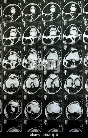 MRT des linken Kniegelenks mit minimalem Gelenkerguss, PHMM-Meniskusdegeneration am Posterior Horn medial, ACL anteriores Kreuzband leichte Verstauchung, n Stockfoto