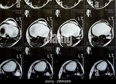 MRT des linken Kniegelenks mit minimalem Gelenkerguss, PHMM-Meniskusdegeneration am Posterior Horn medial, ACL anteriores Kreuzband leichte Verstauchung, n Stockfoto