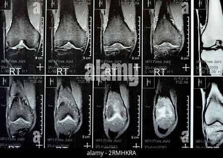 MRT des rechten Knies mit leichtem Gelenkerguss, mit normalen anderen Befunden von PHMM, ACL, MCL, LCL, LM, Bänder, Patella, Sehnen, Nerven, Muskeln Stockfoto