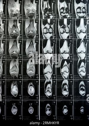 MRT des linken Kniegelenks mit minimalem Gelenkerguss, PHMM-Meniskusdegeneration am Posterior Horn medial, ACL anteriores Kreuzband leichte Verstauchung, n Stockfoto