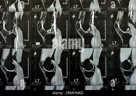 MRT des linken Kniegelenks mit minimalem Gelenkerguss, PHMM-Meniskusdegeneration am Posterior Horn medial, ACL anteriores Kreuzband leichte Verstauchung, n Stockfoto