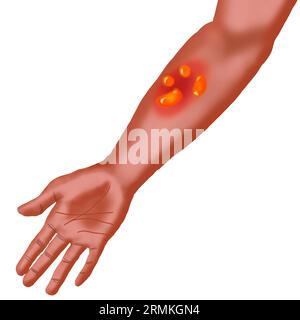 Bullöse Pemphigoid-3D-Darstellung Stockfoto