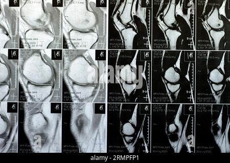 MRT des linken Kniegelenks mit minimalem Gelenkerguss, PHMM-Meniskusdegeneration am Posterior Horn medial, ACL anteriores Kreuzband leichte Verstauchung, n Stockfoto