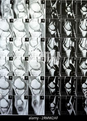 MRT des linken Kniegelenks mit minimalem Gelenkerguss, PHMM-Meniskusdegeneration am Posterior Horn medial, ACL anteriores Kreuzband leichte Verstauchung, n Stockfoto