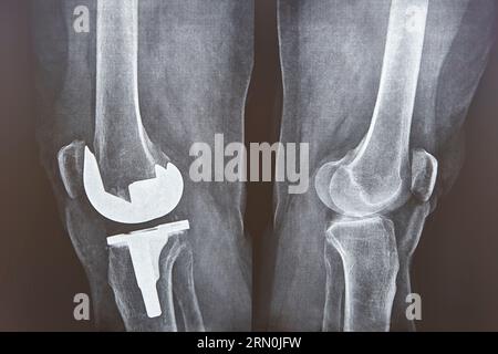 Kniekappenersatz-Röntgenaufnahmen. Titanimplantat. Osteoarthritis. Gelenkknorpel Stockfoto